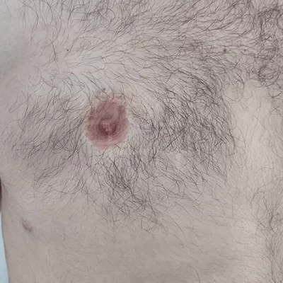 عکس بعد از عمل ژنیکوماستی