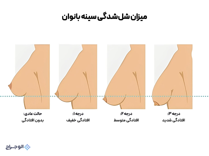 میزان شل‌شدگی سینه بانوان - الو جراح
