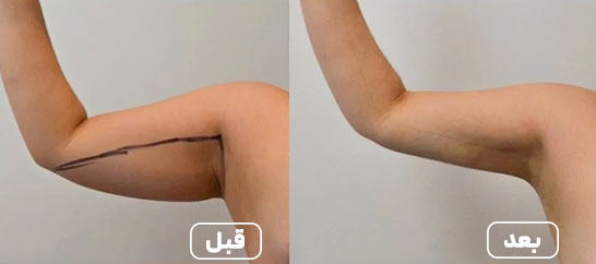 لیپوماتیک-بازو قبل و بعد 1