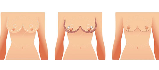 مراحل عمل ماموپلاستی در الو جراح