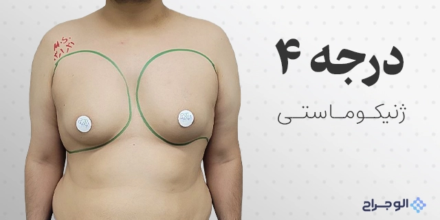 درجه چهار ژنیکوماستی در الو جراح