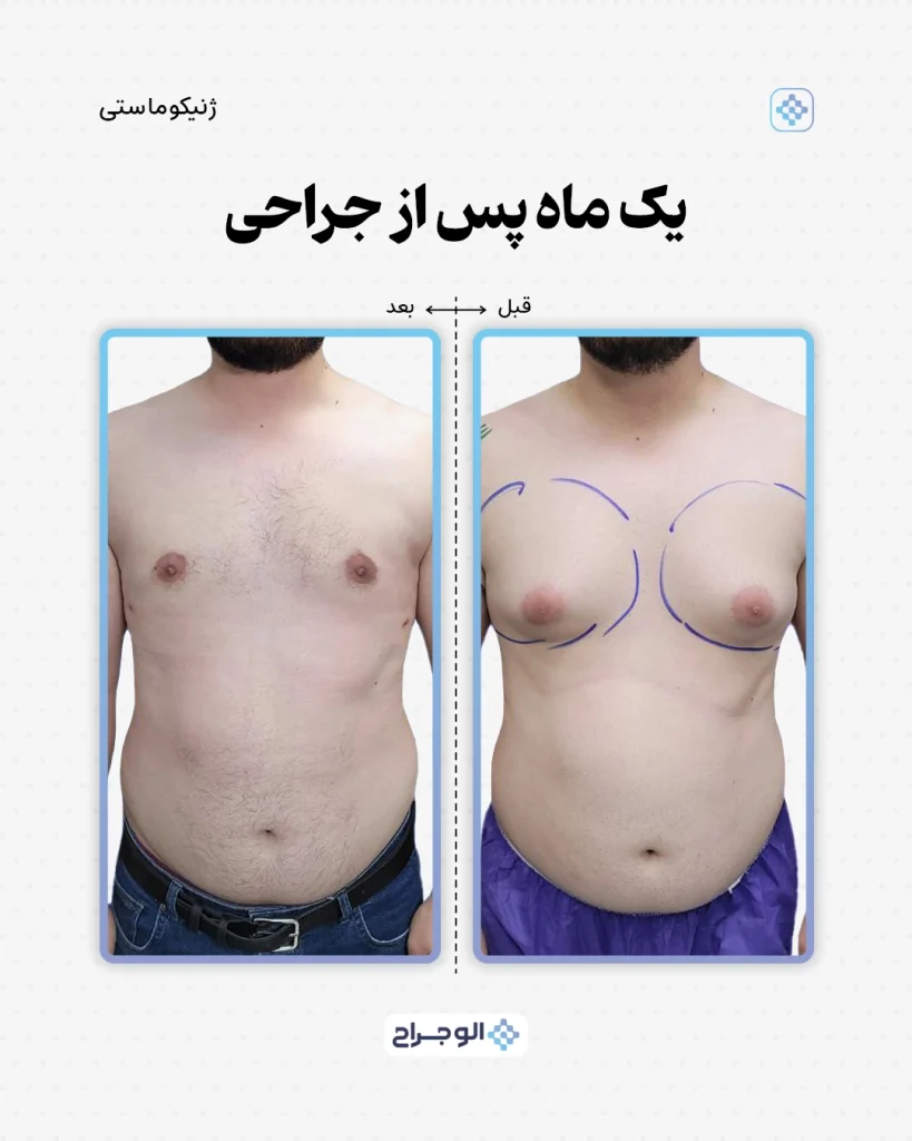 ۱ ماه بعد از جراحی در الو جراح