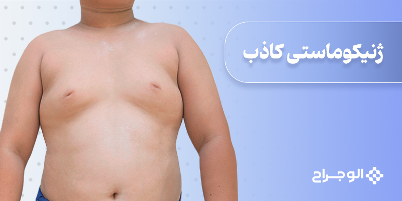 ژنیکوماستی کاذب