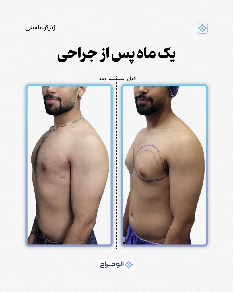 ۱ ماه بعد از جراحی در الو جراح