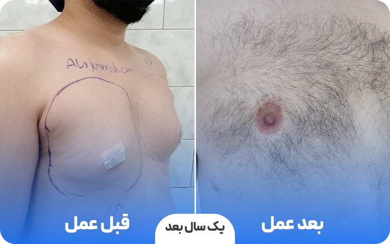قبل و بعد عمل ژنیکوماستی در الو جراح