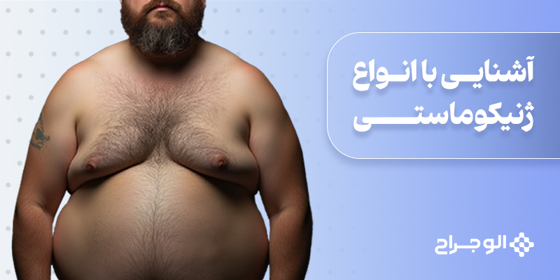 آشنایی با انواع ژنیکوماستی