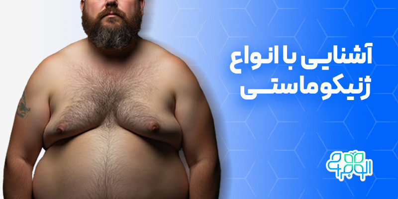 انواع ژنیکوماستی