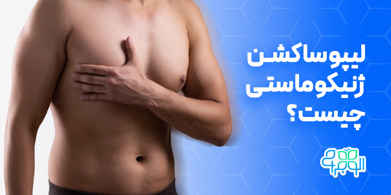 لیپوساکشن ژنیکوماستی
