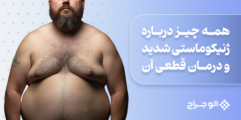 ژنیکوماستی شدید و درمان قطعی آن