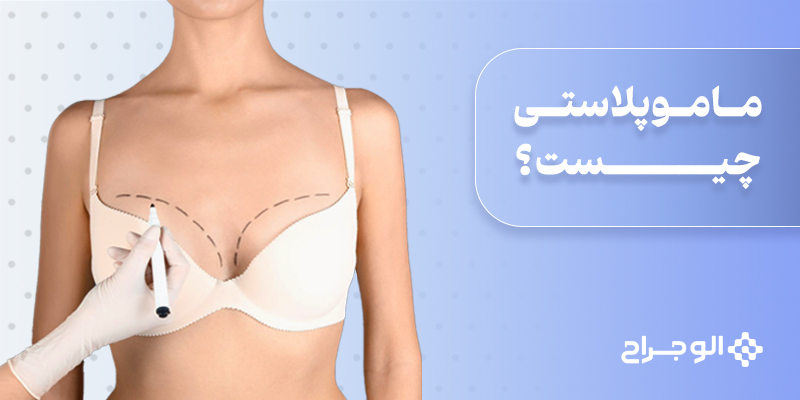 ماموپلاستی چیست؟