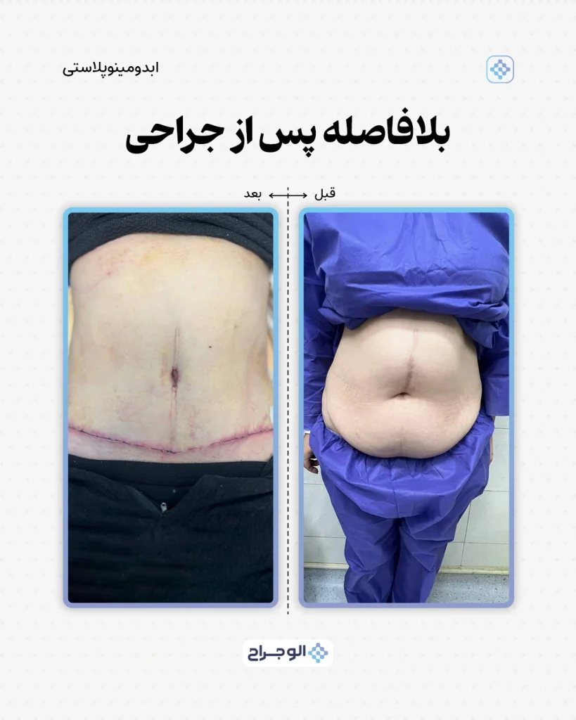 قبل و بعد ابدومینوپلاستی در الو جراح