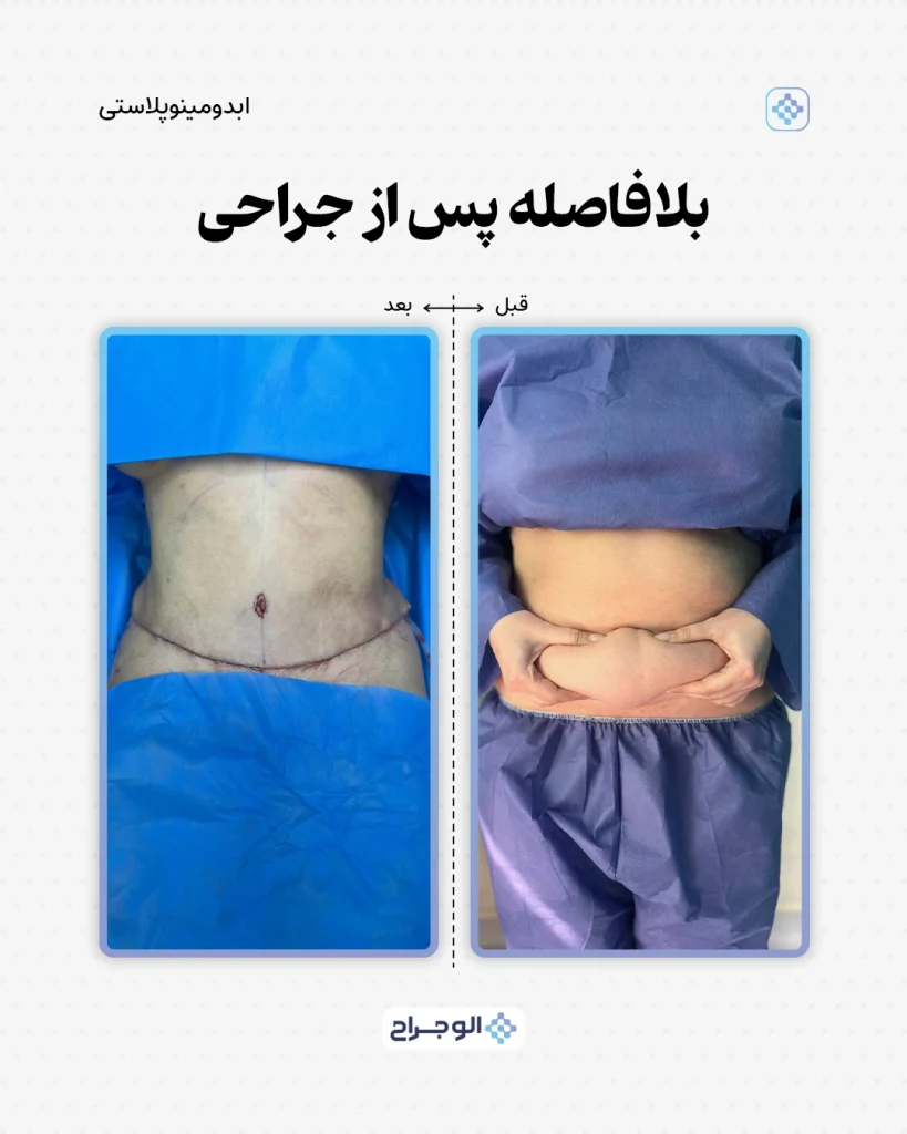قبل و بعد ابدومینوپلاستی در الو جراح