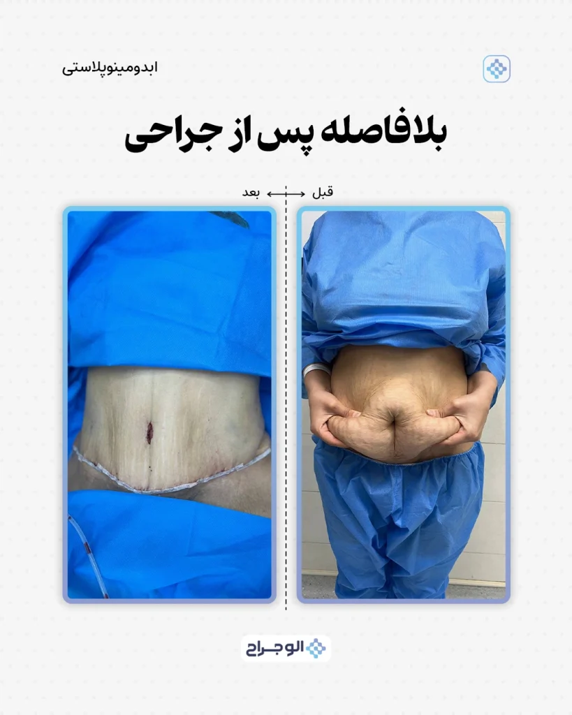 قبل و بعد ابدومینوپلاستی در الو جراح