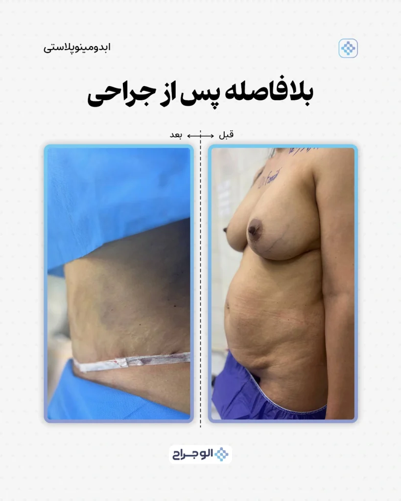 قبل و بعد ابدومینوپلاستی در الو جراح