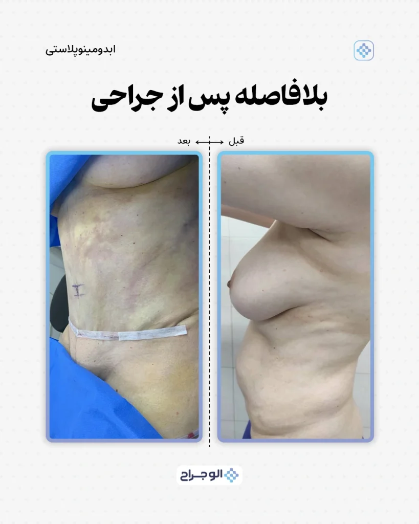 قبل و بعد ابدومینوپلاستی در الو جراح