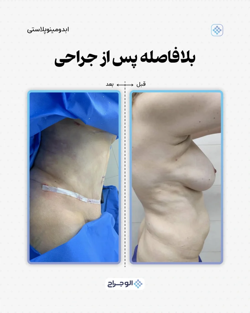 قبل و بعد ابدومینوپلاستی در الو جراح