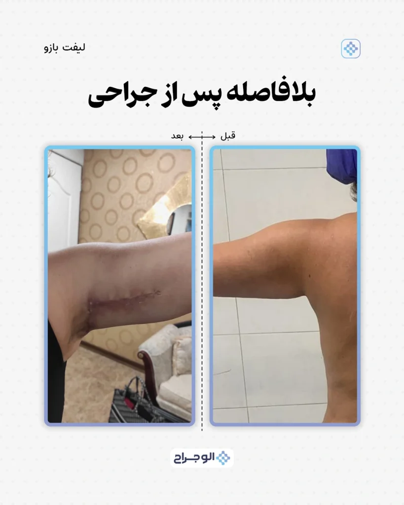 قبل و بعد لیپو بازو در الو جراح