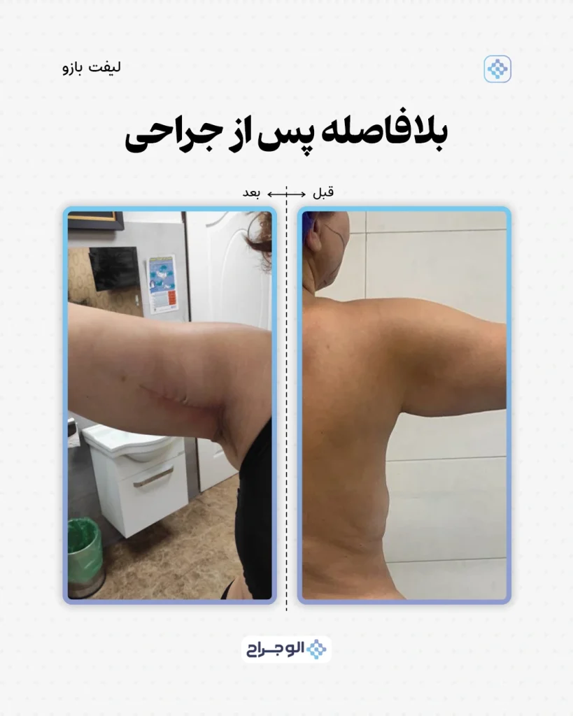 قبل و بعد لیپو بازو در الو جراح