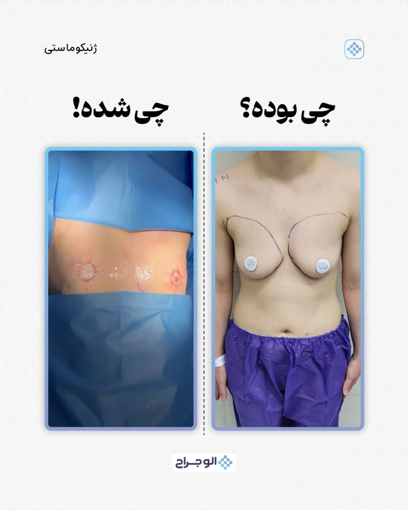 نمونه جراحی تخلیه سینه در الو جراح