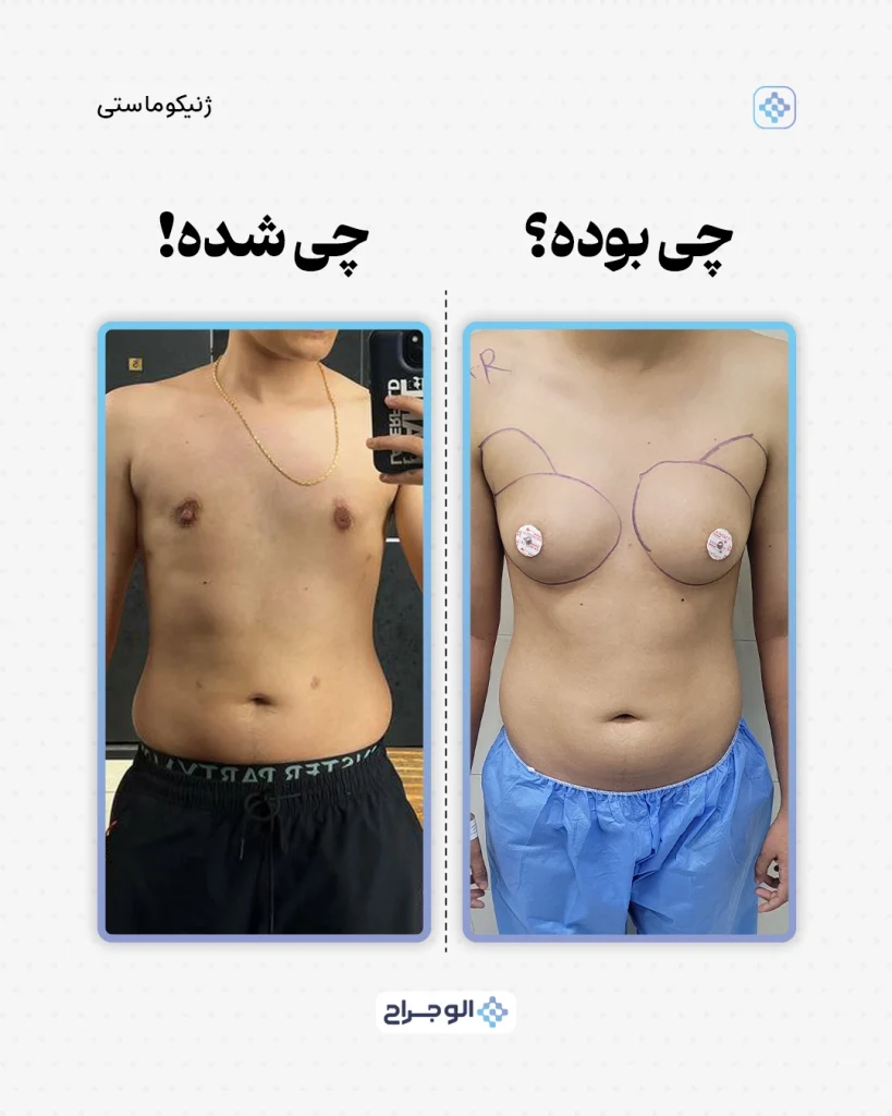 نمونه جراحی تخلیه سینه در الو جراح