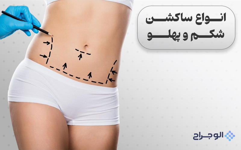 انواع ساکشن شکم و پهلو