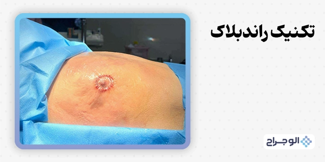 تکنیک راندبلاک در الو جراح