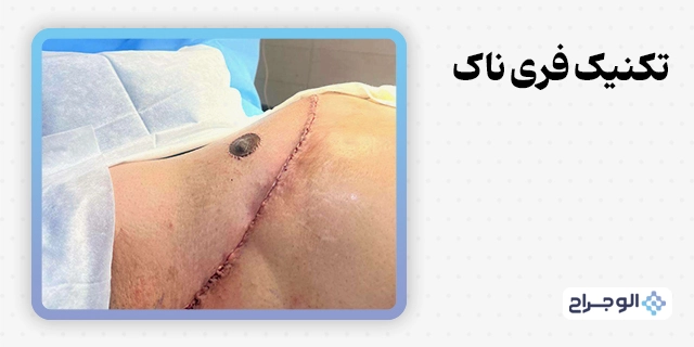 تکنیک فری‌ناک در الو جراح - یکی از روش‌های جراحی تخلیه سینه ترنس