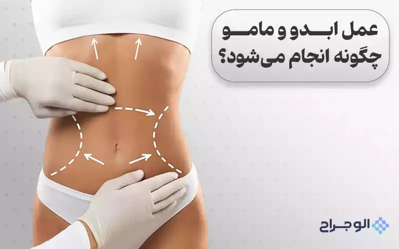 عمل ابدو و مامو چگونه انجام میشود؟