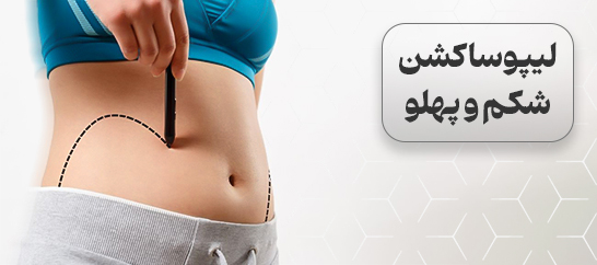 لیپوساکشن شکم و پهلو