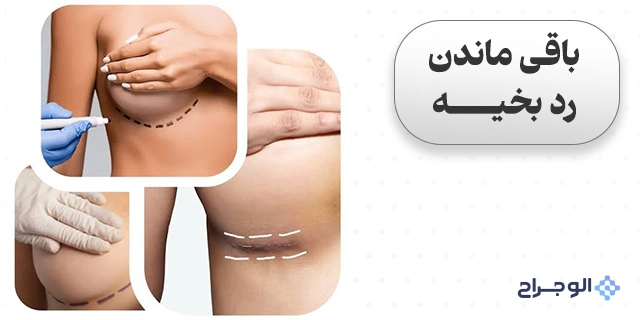 باقی‌ماندن رد بخیه - الو جراح