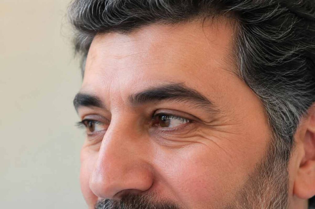 بوتاکس خطوط پنجه کلاغی مردا