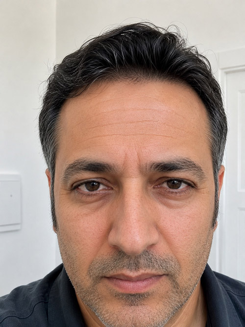 بوتاکس مرد