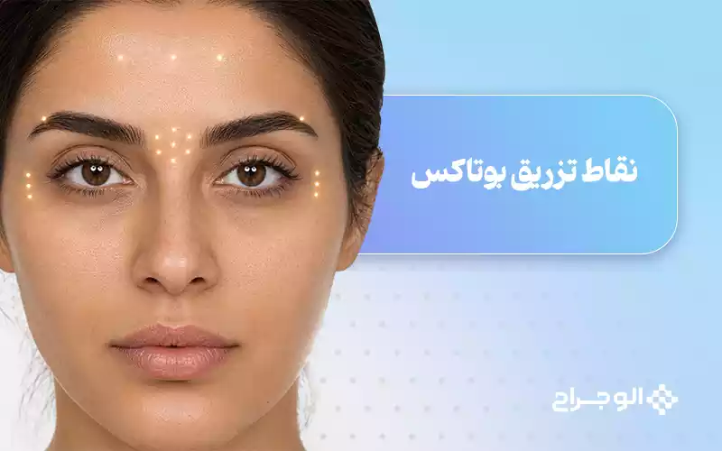 نقاط تزریق بوتاکس